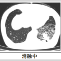 隨州市中心醫(yī)院：【特色技術(shù)】微創(chuàng)技術(shù)新突破，冷凍消融治療精準“凍殺”癌細胞