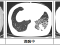 隨州市中心醫(yī)院：【特色技術(shù)】微創(chuàng)技術(shù)新突破，冷凍消融治療精準(zhǔn)“凍殺”癌細胞
